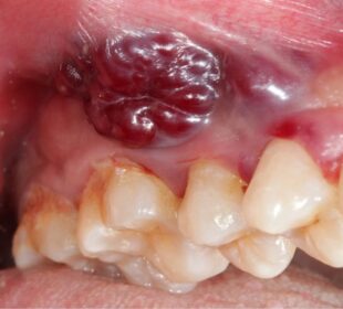 Surgical Removal