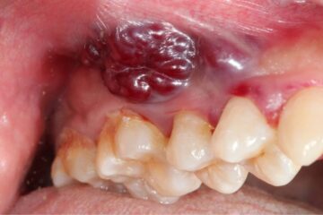 Surgical Removal