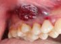 Surgical Removal